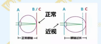 哪個(gè)年齡近視度數(shù)最容易增長？