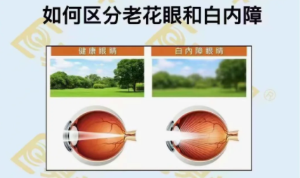 如何區(qū)分老花眼和白內(nèi)障？